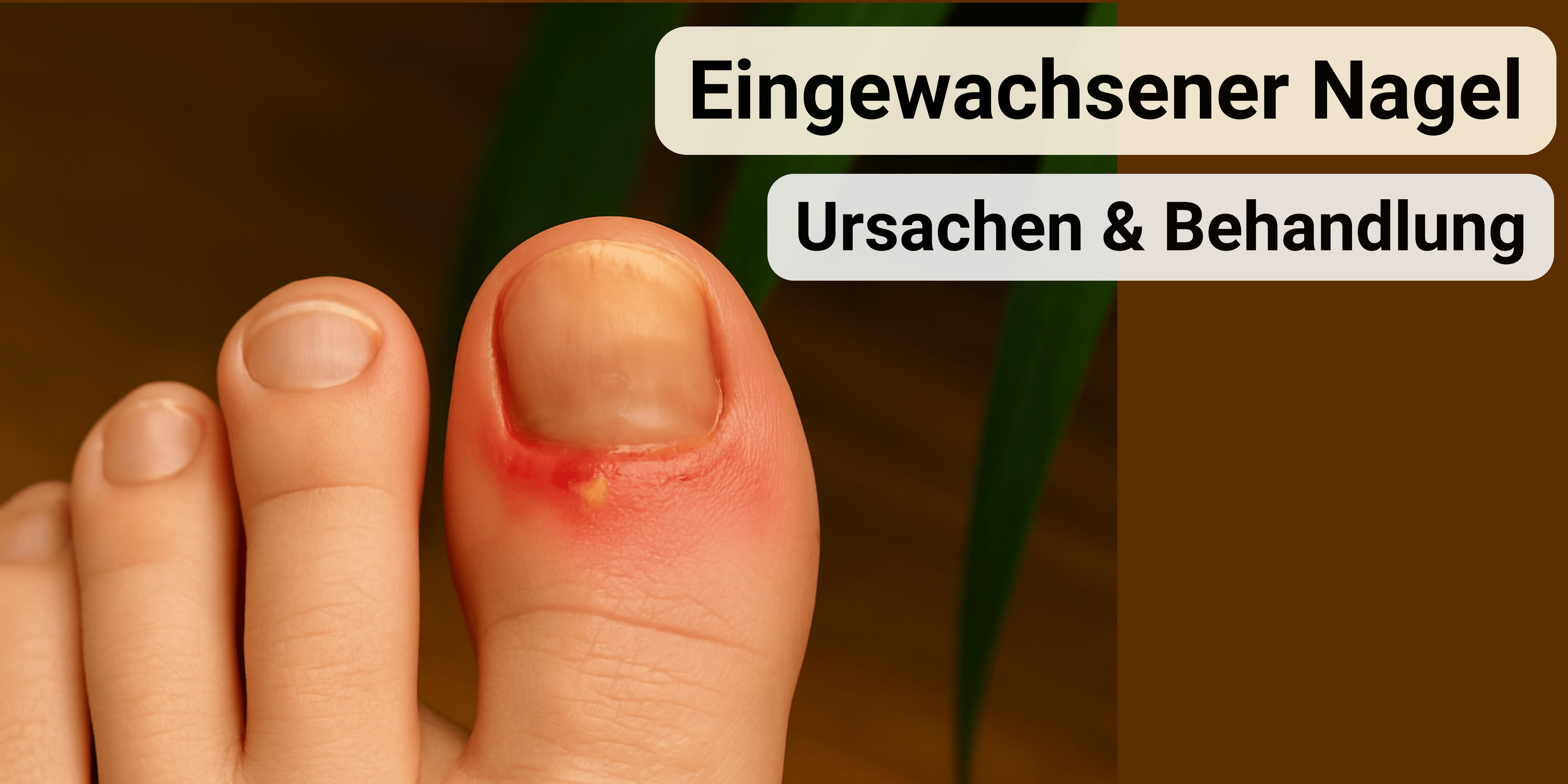 Eingewachsener Nagel: Ursachen, Symptome & effektive Hilfe - Doktor Health