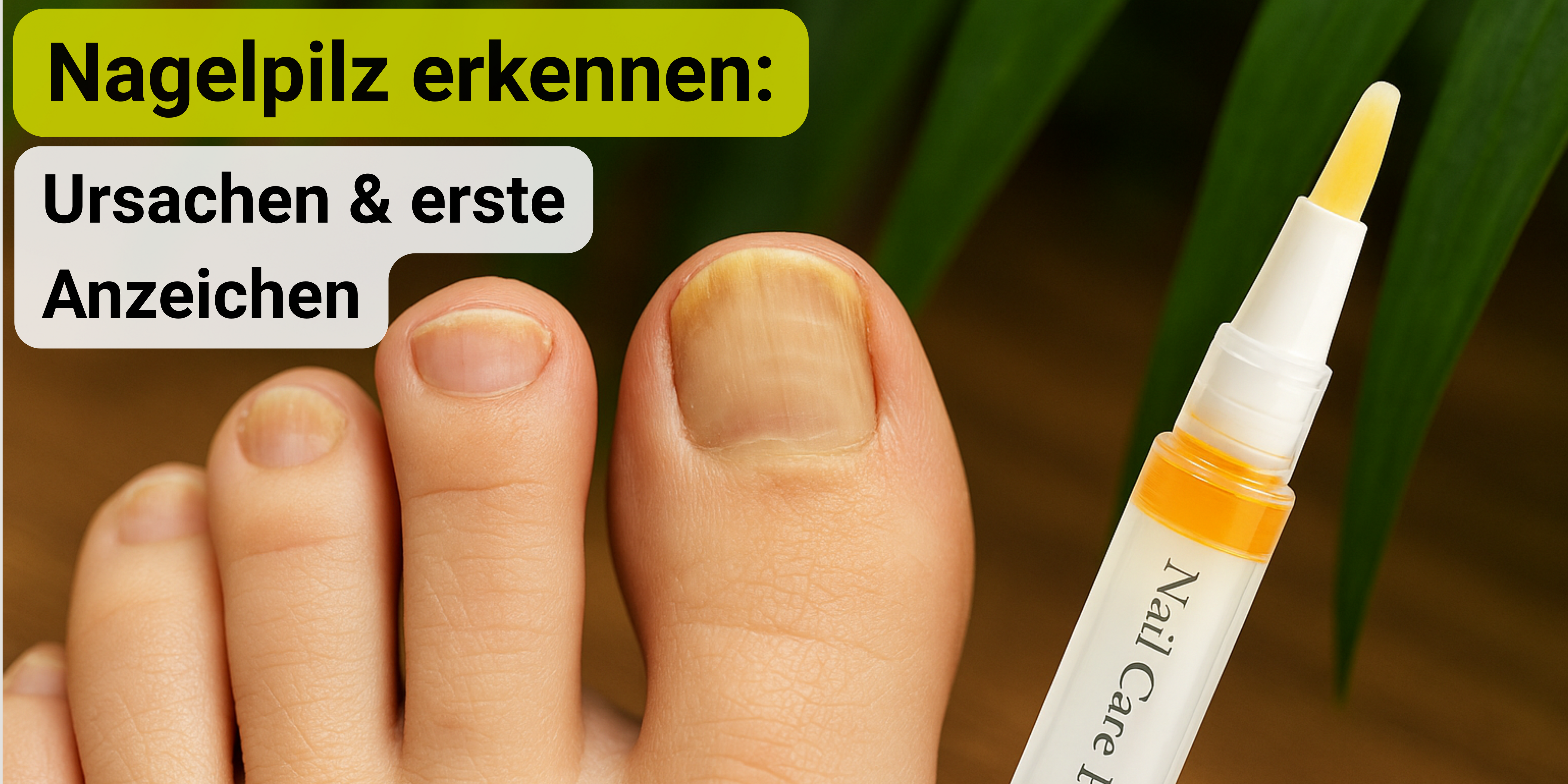 Nagelpilz verstehen: Ursachen und erste Anzeichen erkennen
